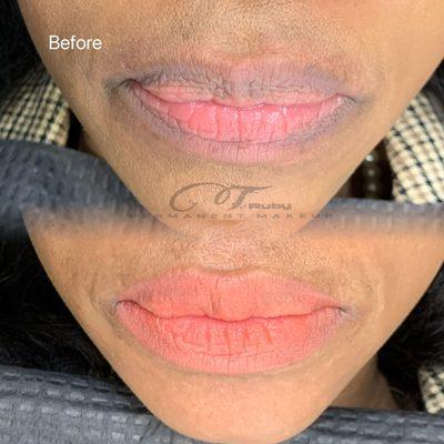 Lip enhancement
Lips: * Natural: $500