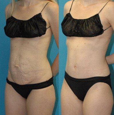 Tummy Tuck surgery with Sound Plastic Surgery