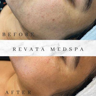 Revata Medspa Laser Facial with Microdermabrasion and skin Treatment