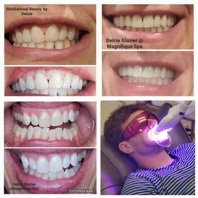 Cosmetic Teeth Whitening