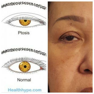 Lan states my mom does NOT have ptosis? States she already had eye surgery? Ahem, my mom is half caucasian/french - no eye surgery,  lady