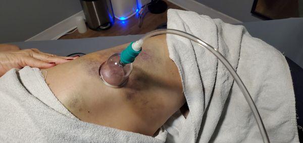 Cupping for hematoma and facilitate healing and blood flow after a fall