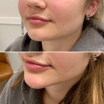 A chin filler performed by Solana.