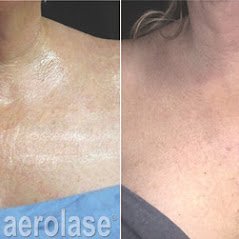 Skin rejuvenation of neck and decollete area. before & after picture