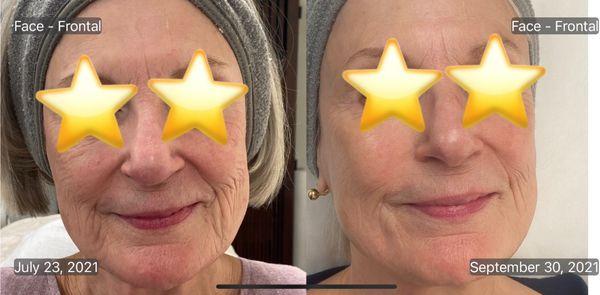 Laser Skin Resurfacing