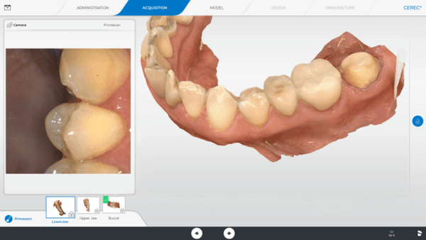 CEREC single appointment porcelain restorations