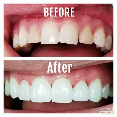 6 Veneers Before and After