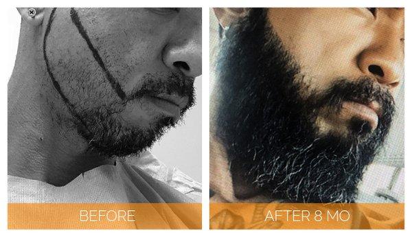 40-year old Nashville Hair Doctor beard transplant patient 8 months post-op.