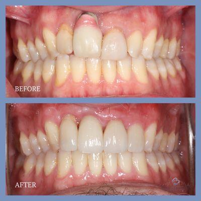 Veneer and Implant Crown Before and After