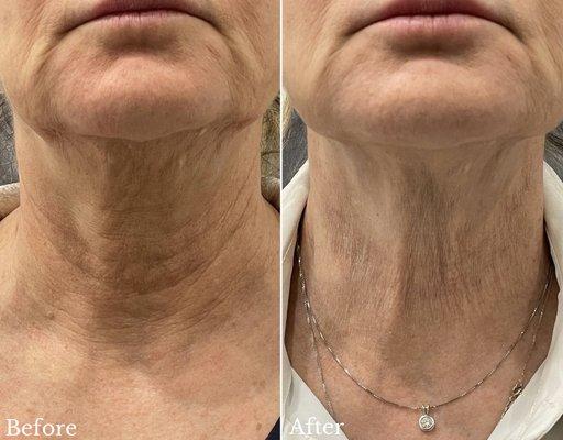 Neck treatment