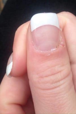 The bleeding has stopped, but the nail still looks messy. Look closely people- there is a BLACK HAIR underneath the acrylic