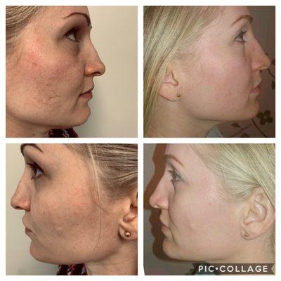 RF Skin Resurfacing