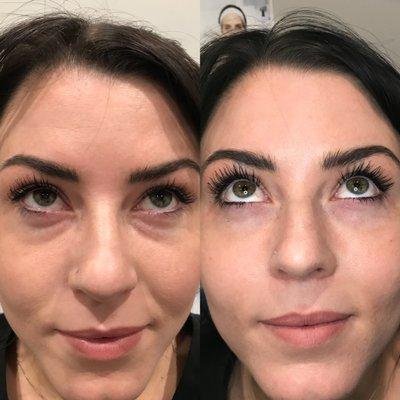 Tear Through correction using natural hyaluronic acid filler