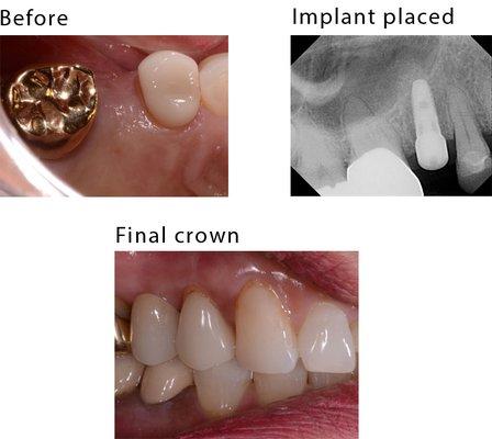 This patient is very happy with a beautiful implant-supported ceramic crown.