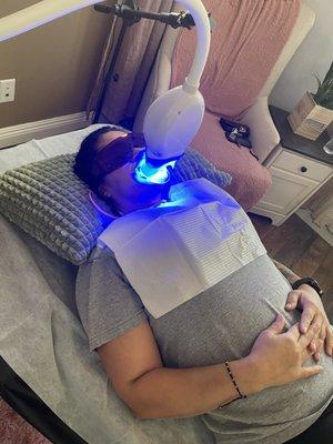 Teeth whitening