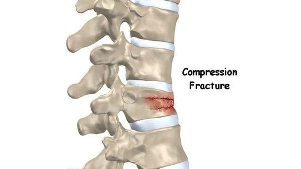 Compression Fracture