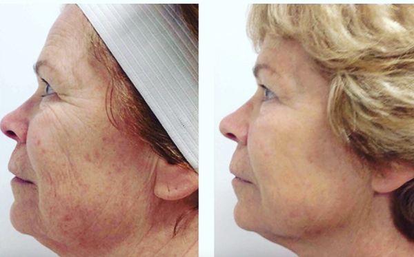 The Vivace Experience
Stimulate collagen production for more volume and tighter skin without discomfort.