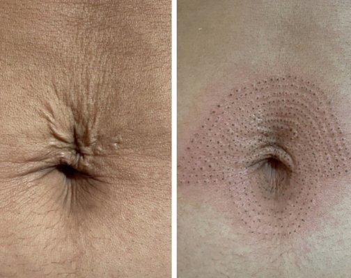 Fibroblast treatment before and after