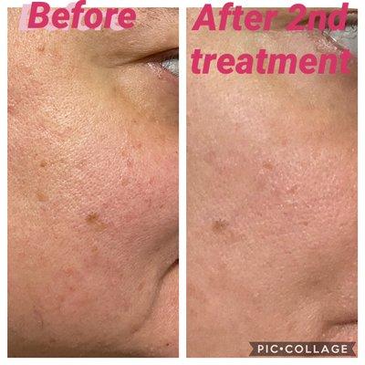 PRP FACIAL