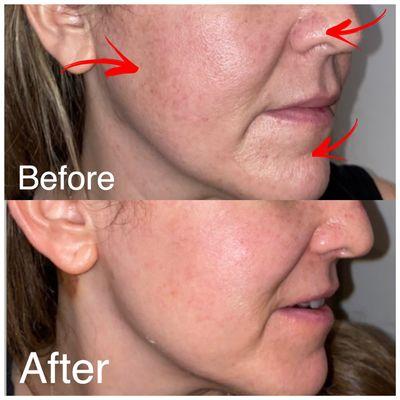 Beautiful results from ADVA Laser Facials & Microneedling with Radiofrequency.