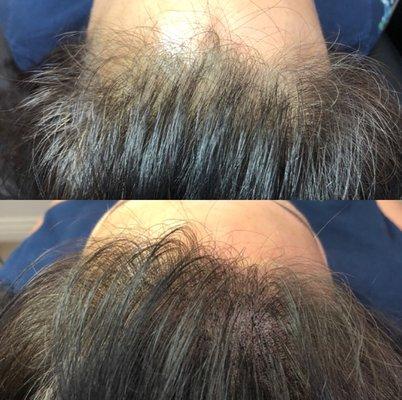 Scalp Micropigmentation