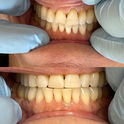 Before and after on tooth contouring and filling.  Amazing and super cheap compared to laminates.