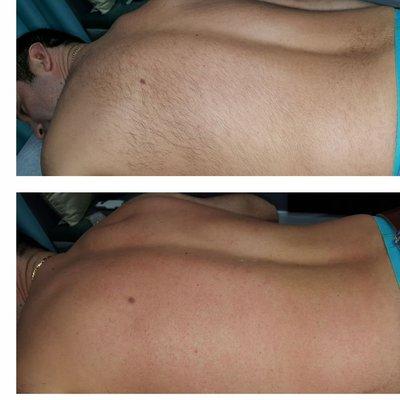 Back wax Before and After