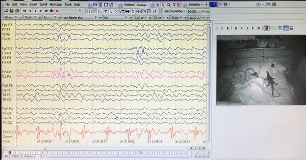 24/7/365 EEG Video Telemetry Monitoring