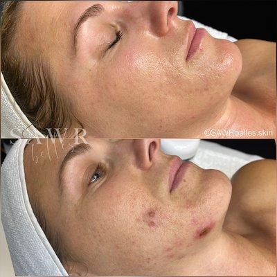 Acne revision with Enzyme treatments