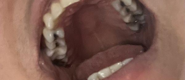 Can you spot the wrong size crown ? It's huge.   My top right molar . Also compare that size to my natural top left molar .