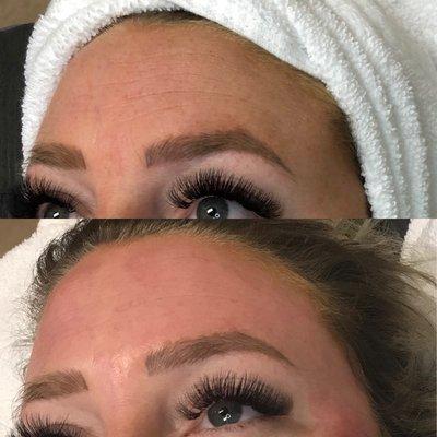 Before & After first HydraFacial Treatment.