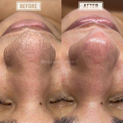 Clarifying Facial