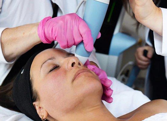 Exion Microneedling