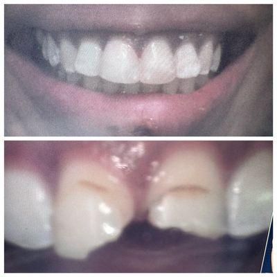 Same day fillings two hours into smile restoration 48hrs following traumatic fall