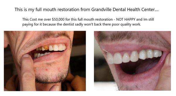 This work was done at Grandville Dental Health Center.