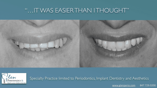 Extreme makeover case, performed by a team of Periodontist, Prosthodontist and a talented  lab  technician. All at one location - Glen Perio