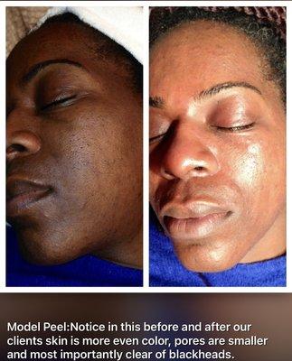 Light Peel with dermabrasion