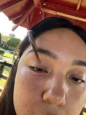 Did not put on goggles when microneedling so my eye got swollen