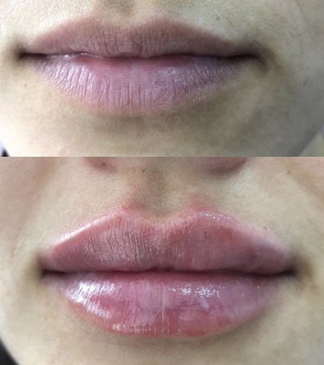 Signature Lip Filler