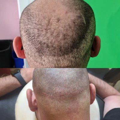 Transplant scar? SMP can conceal any scar on the head in a matter of hours.