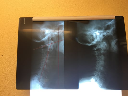 A cervical xray after a correctional careplan.