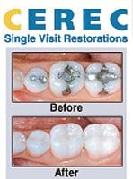 CEREC Before and After