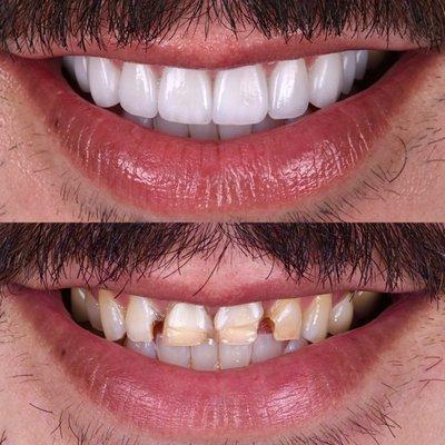 Full upper arch rehabilitation with implants, crowns and veneers by Dr. Kasra Tajik