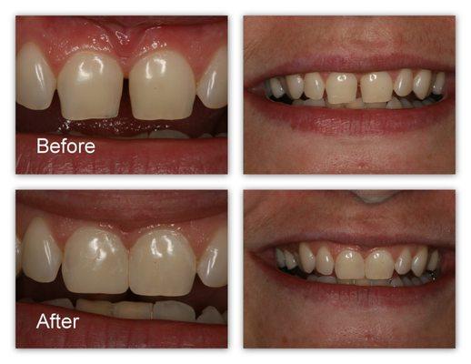 Dr. Hosner bonded  material to the teeth to cosmetically enhance.