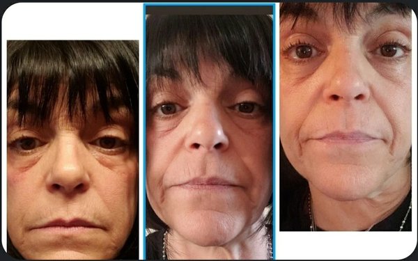 Microneedling