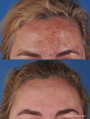 Zo Skin Health products and our services can help clear up pigment problems