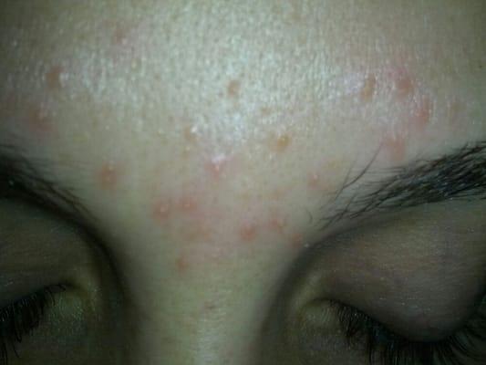 Full of pimples a full week after threading at Bina's