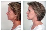 Before and After Photo from our Toning Facial series.