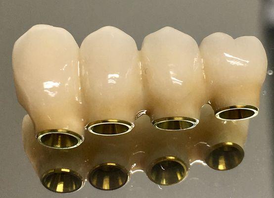 Custom made porcelain to zirconium implant retained four unit bridge with anodized gold color titanium cad abutments.