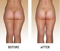 El antes y el después de un cuerpo tratado con Lipomassage de endermologie.